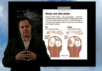 stroke and mini stroke