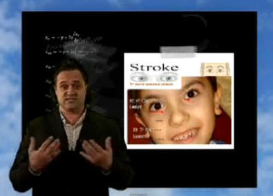 stroke in a child's face